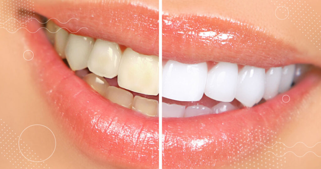 Popular Cosmetic Dental Treatments to Get Your Smile Ready for the Holidays